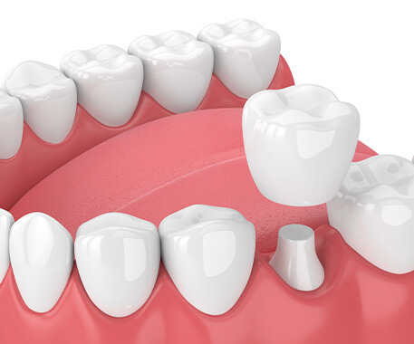 illustration of a dental crown