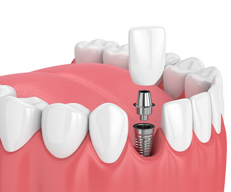 illustration of a dental implant